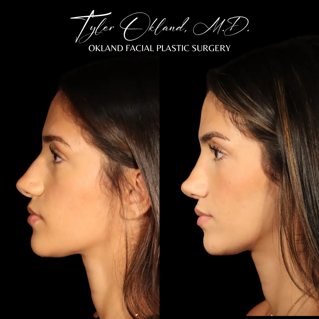 Case 1: Rebuilding Tip Support With Autologous Rib Cartilage revision rhinoplasty case image 9