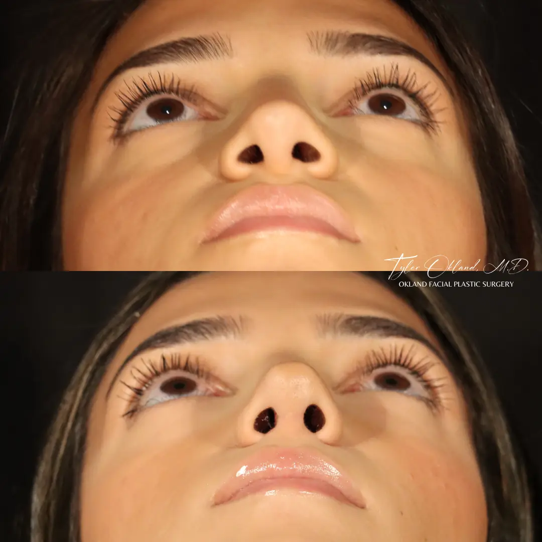 Case 1: Rebuilding Tip Support With Autologous Rib Cartilage revision rhinoplasty case image 10