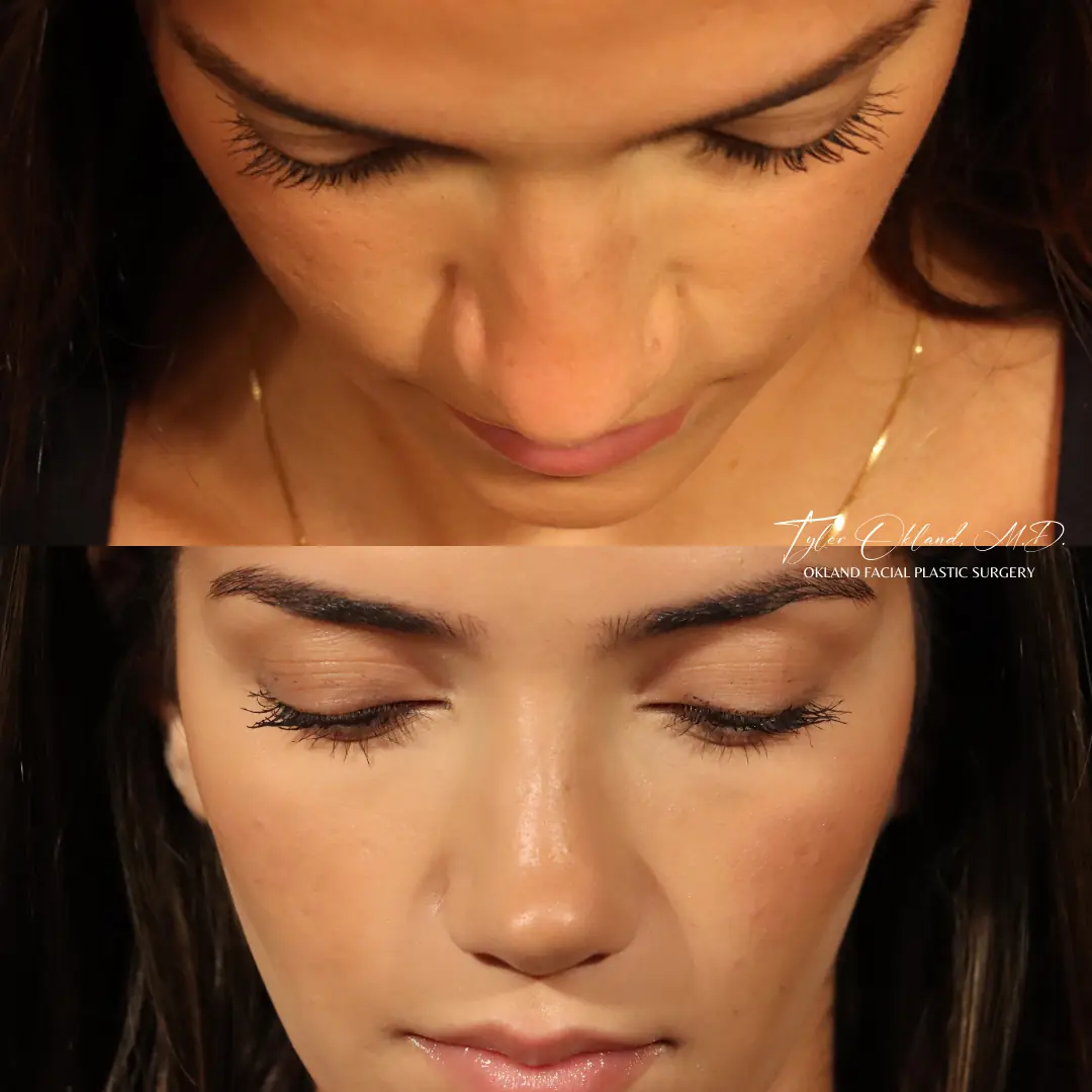 Case 1: Rebuilding Tip Support With Autologous Rib Cartilage revision rhinoplasty case image 11