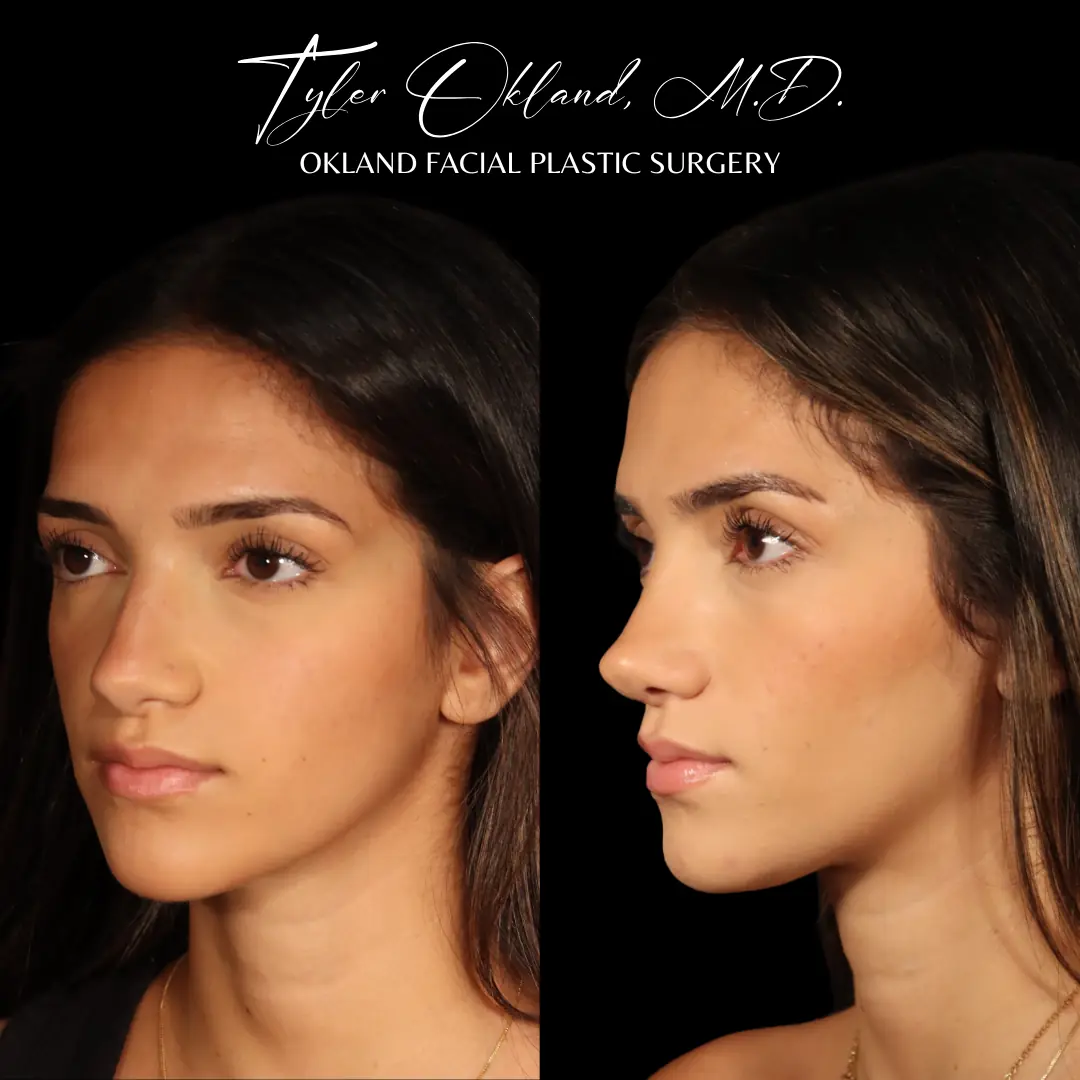 Case 1: Rebuilding Tip Support With Autologous Rib Cartilage revision rhinoplasty case image 12