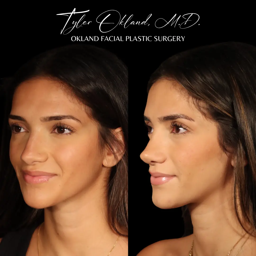 Case 1: Rebuilding Tip Support With Autologous Rib Cartilage revision rhinoplasty case image 13