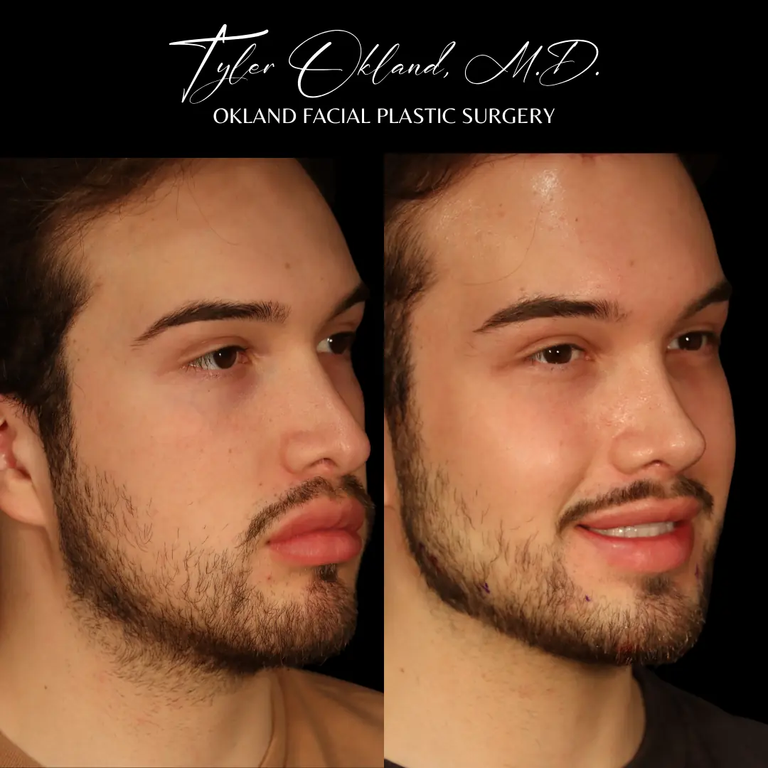 Revision rhinoplasty structural diagnosis and result — view 2