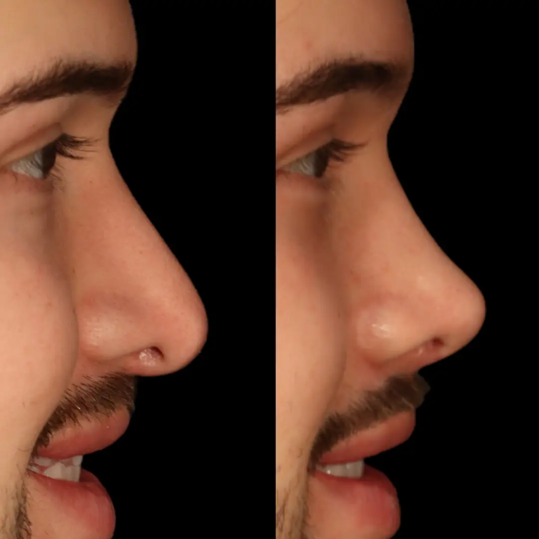 Revision rhinoplasty structural diagnosis and result — view 3