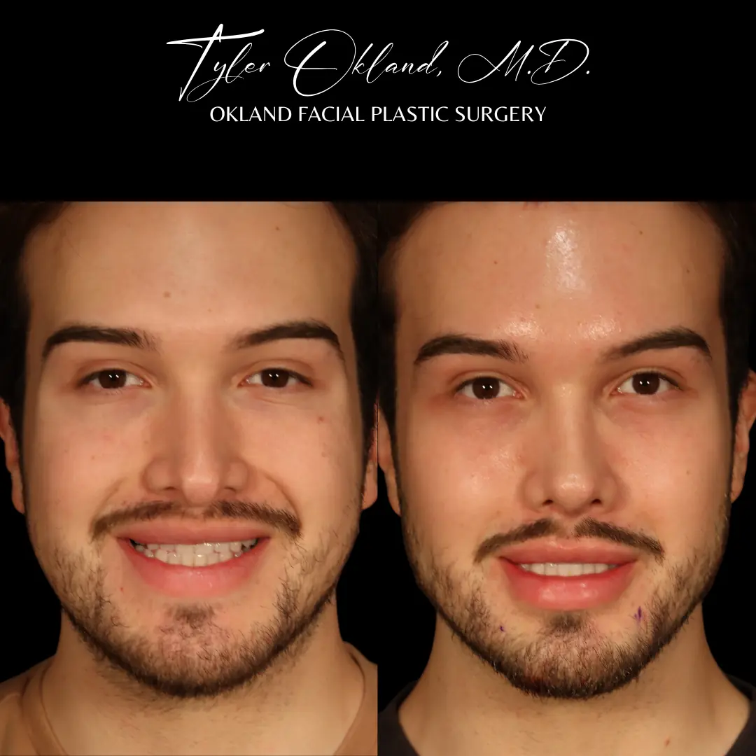 Case 2: Rebuilding an Over-Resected Tip and Correcting an Inverted-V Deformity revision rhinoplasty case image 10