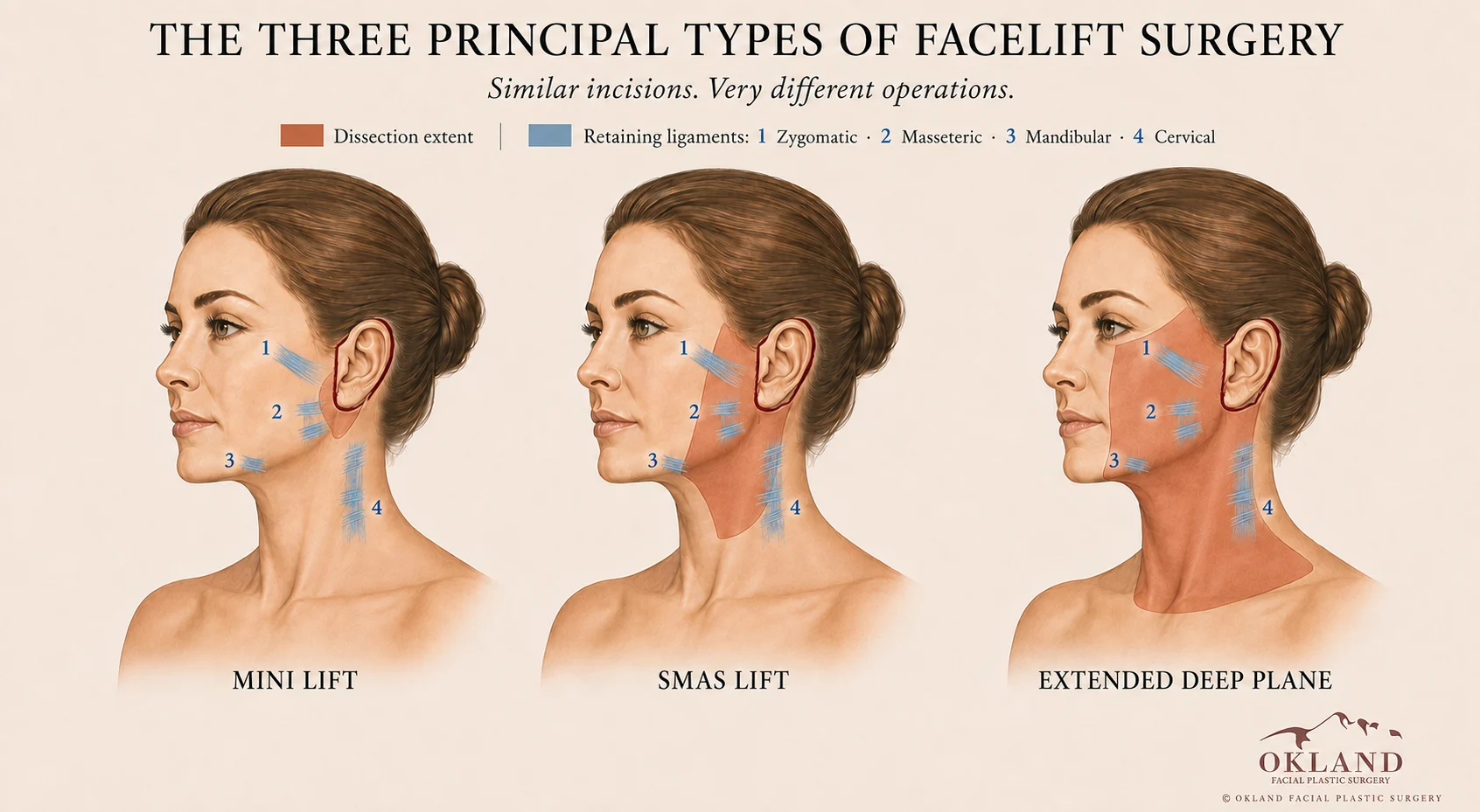 Medical illustration comparing three principal types of facelift surgery.