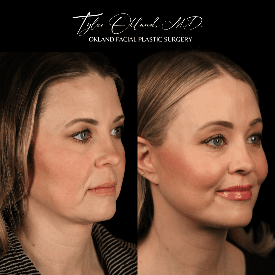 Three-quarter before-and-after facelift result view.