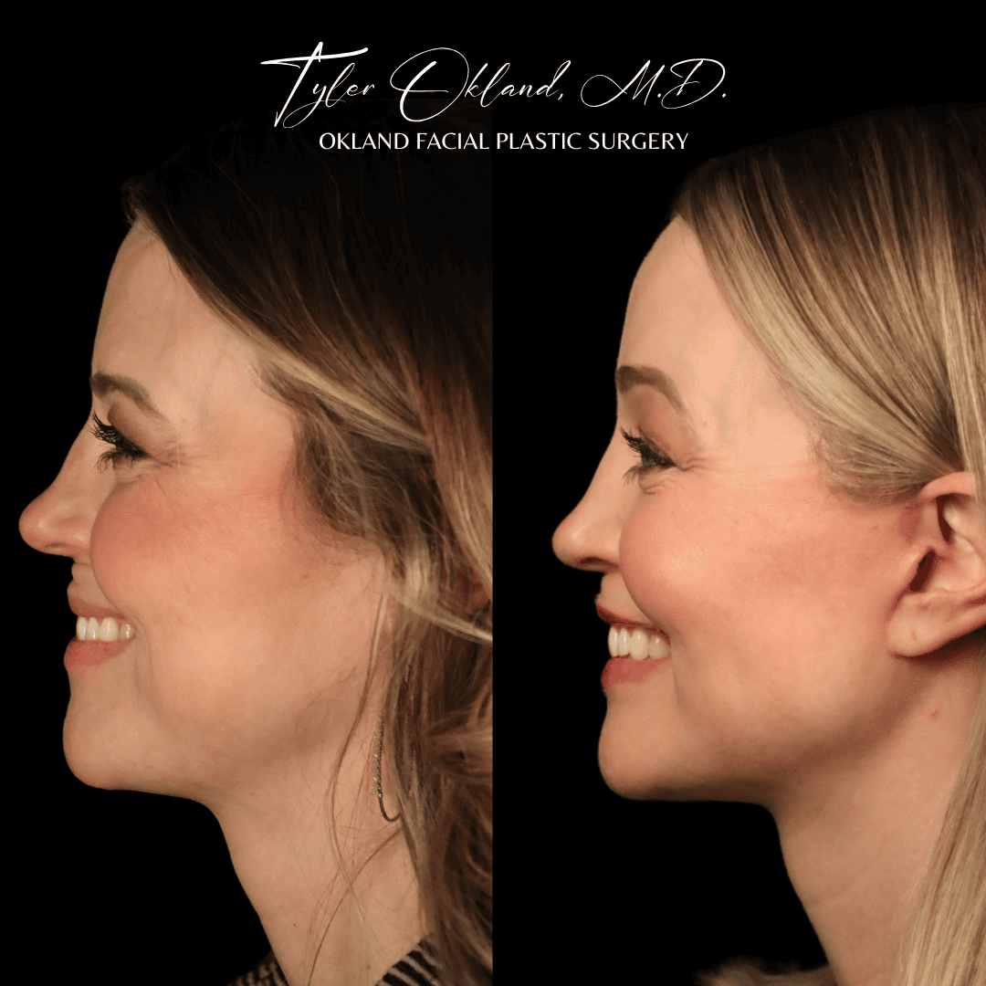 Profile before-and-after facelift result view.