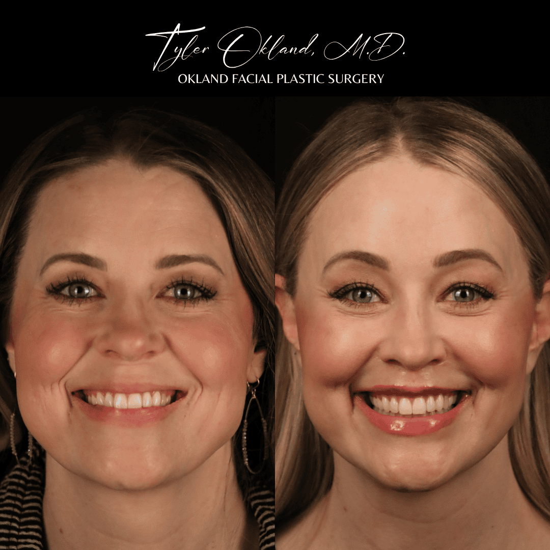 Frontal before-and-after facelift result view.