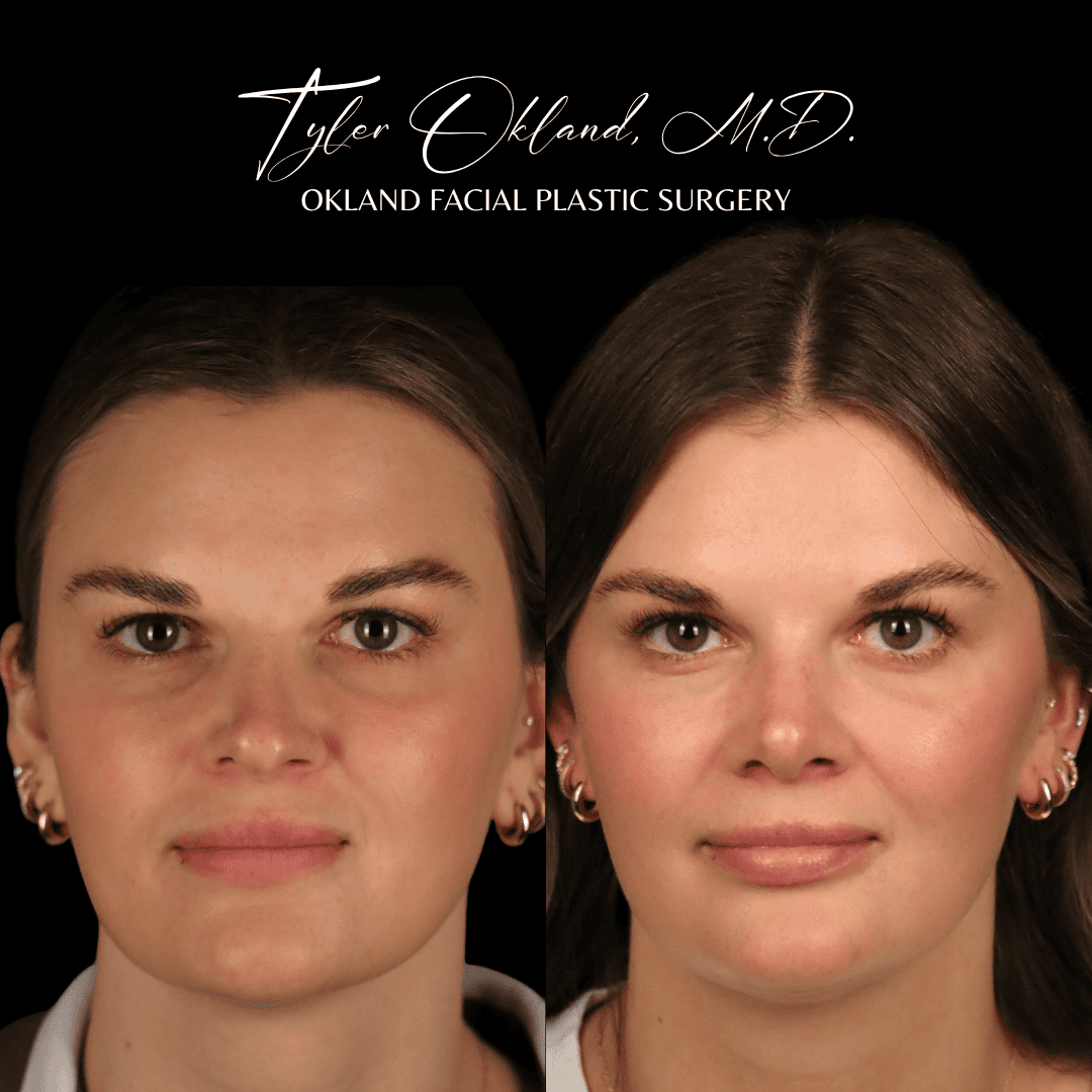 Before and after primary rhinoplasty result by Dr. Tyler Okland in Denver, case 10