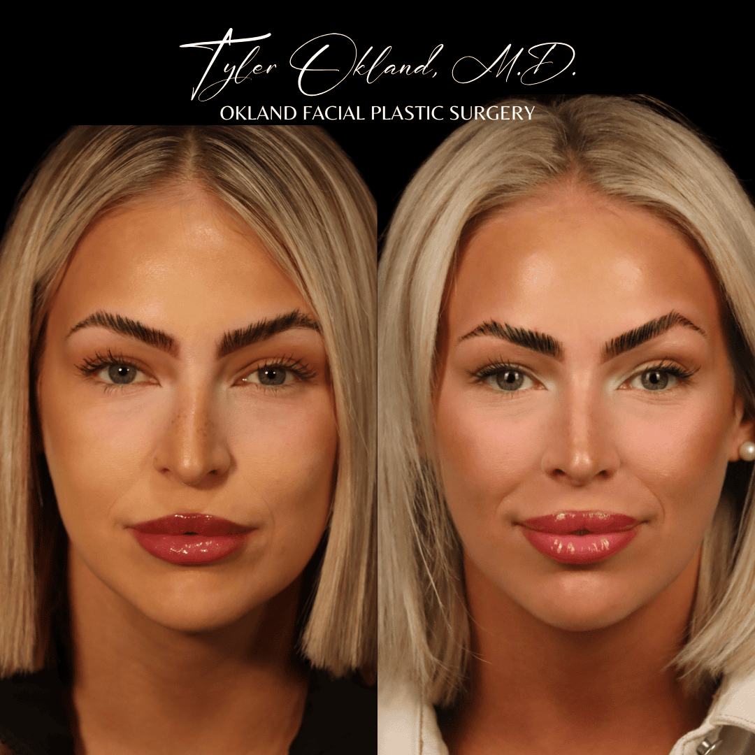 Before and after primary rhinoplasty result by Dr. Tyler Okland in Denver, case 04