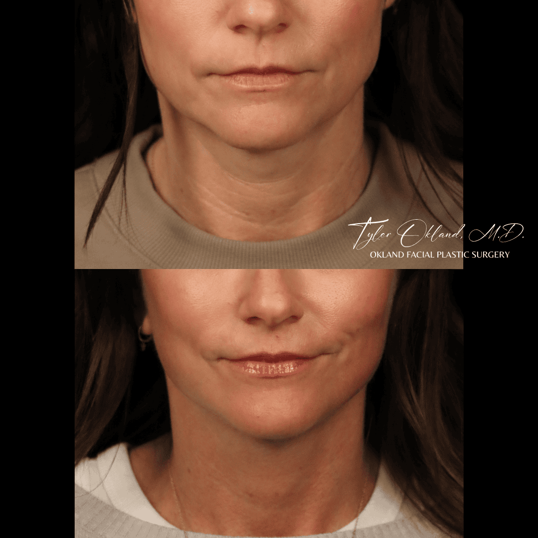 Before and after extended deep plane facelift and facial rejuvenation by Dr. Tyler Okland in Denver, case 12