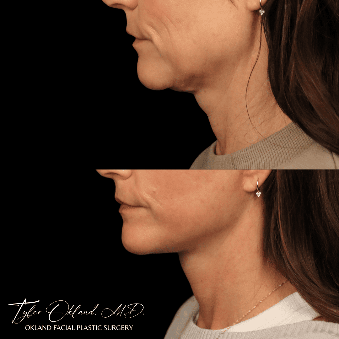 Extended deep plane facelift and deep neck lift result at three months