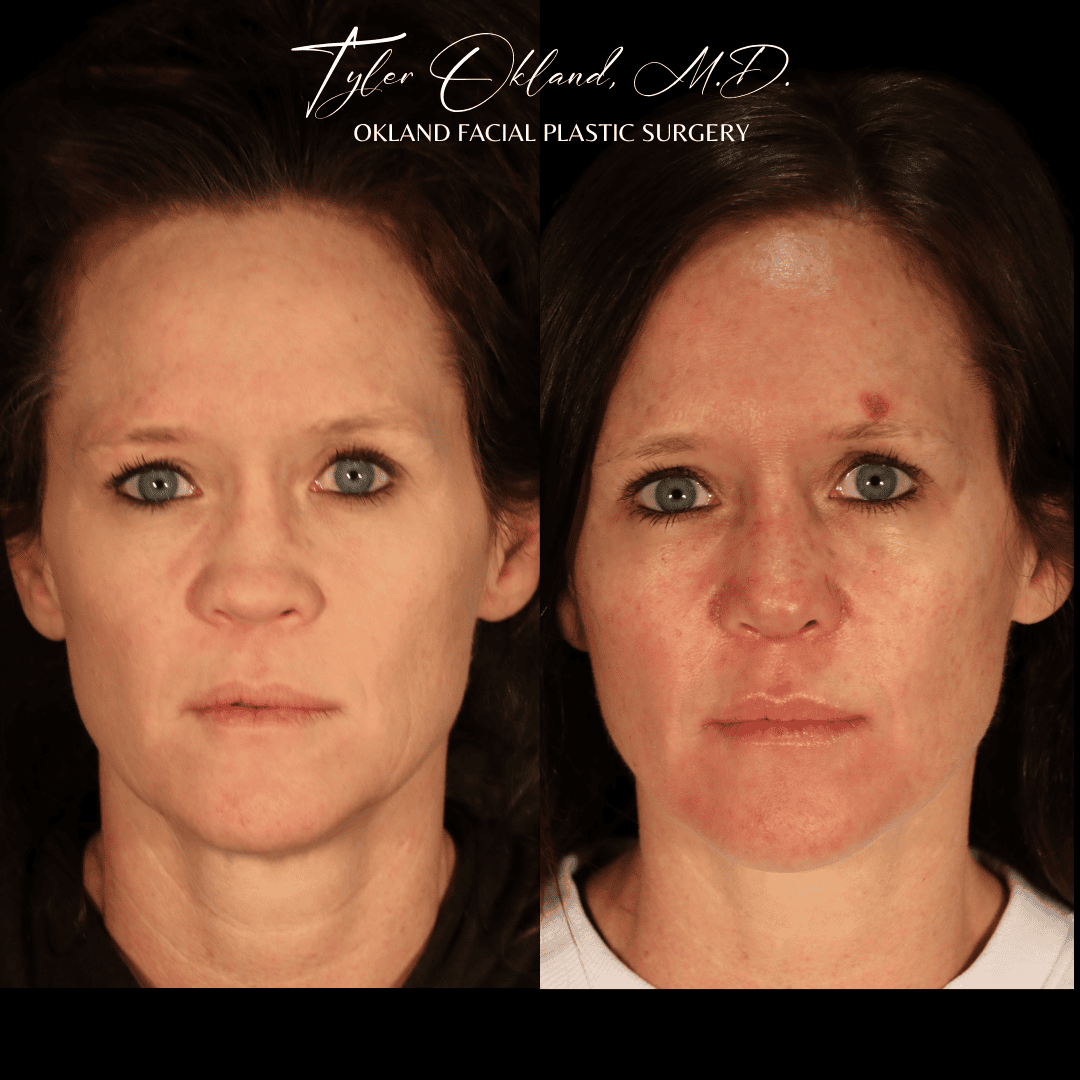 Frontal before and after revision rhinoplasty result by Dr. Tyler Okland in Denver, case 07