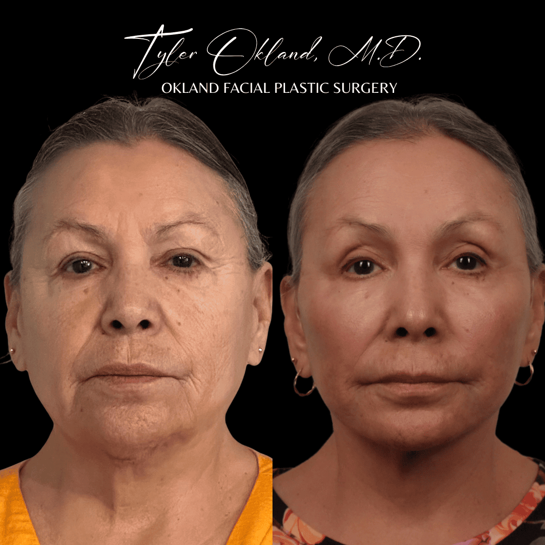 Before and after revision extended deep plane facelift and facial rejuvenation by Dr. Tyler Okland in Denver, case 11