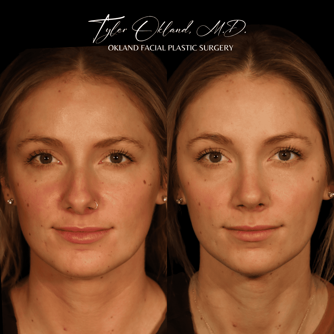 Before and after primary rhinoplasty result by Dr. Tyler Okland in Denver, case 11
