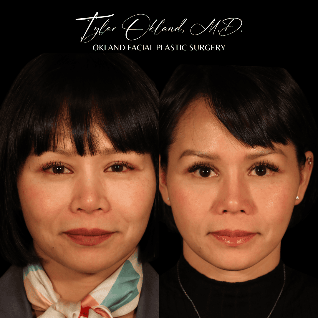 Before and after primary rhinoplasty result by Dr. Tyler Okland in Denver, case 12