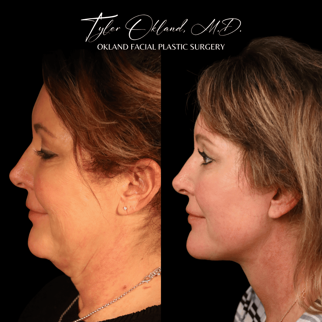 Gallery Case 07 comprehensive facial rejuvenation result