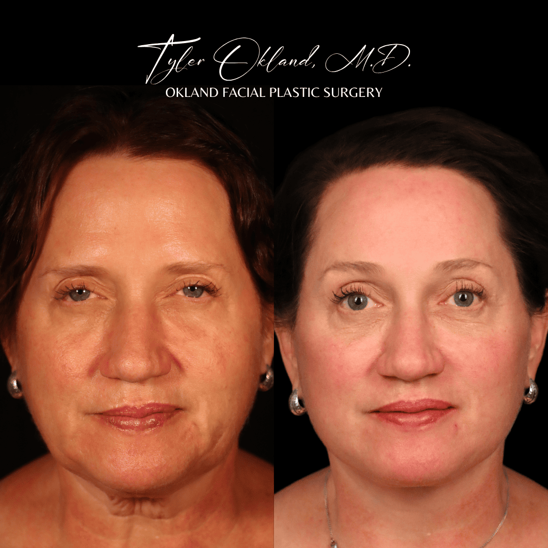 Before and after deep plane facelift and facial rejuvenation by Dr. Tyler Okland in Denver, case 10