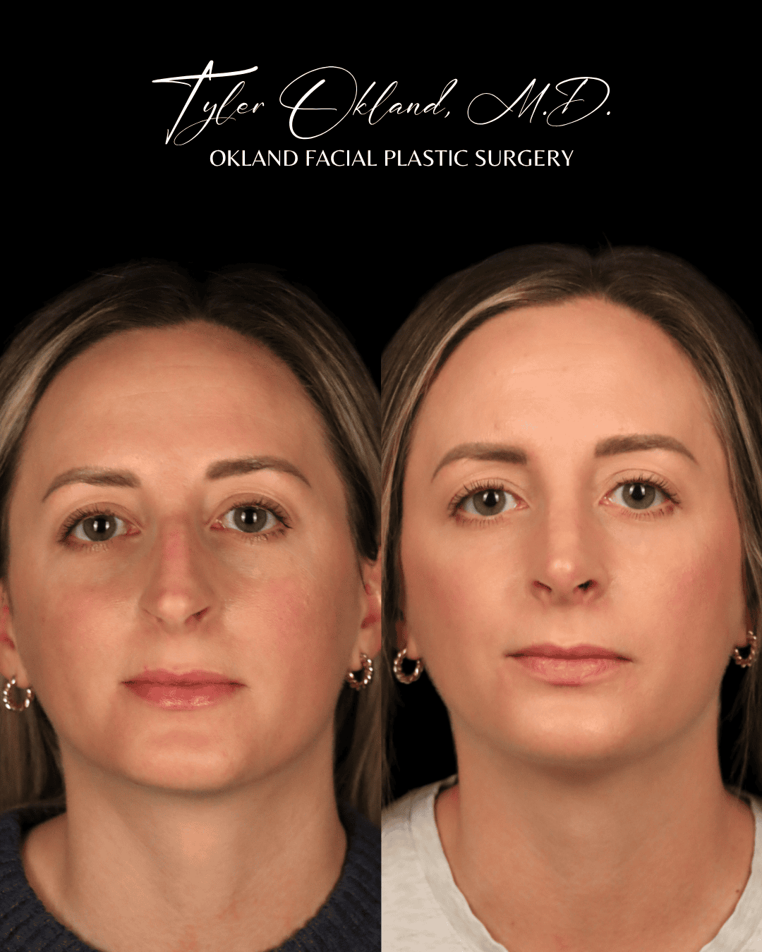 Before and after primary rhinoplasty result by Dr. Tyler Okland in Denver, case 09