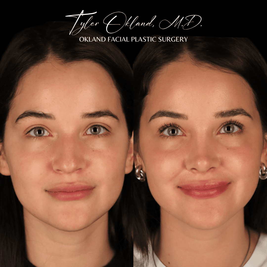 Front view before and after primary rhinoplasty performed by Dr. Tyler Okland in Denver