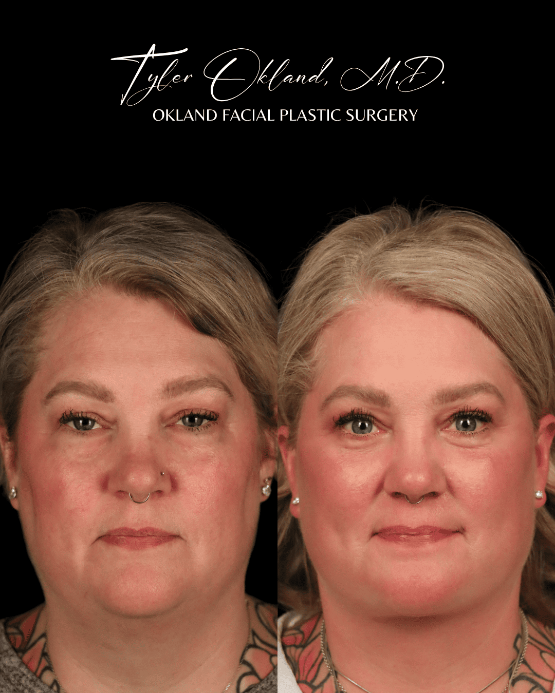 Before and after extended deep plane facelift and facial rejuvenation by Dr. Tyler Okland in Denver, case 09