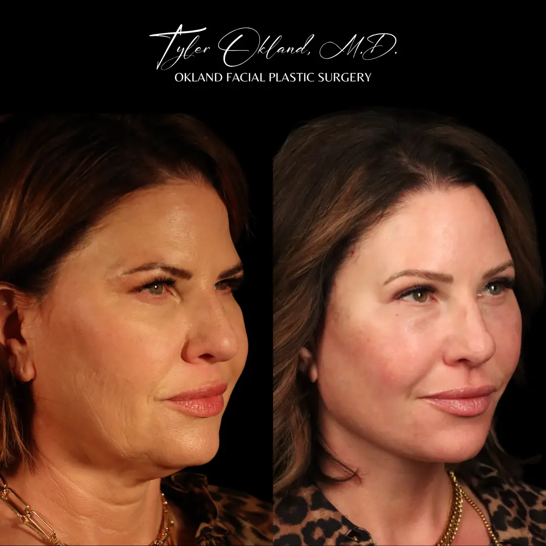 Face and neck rejuvenation before and after result by Dr. Tyler Okland