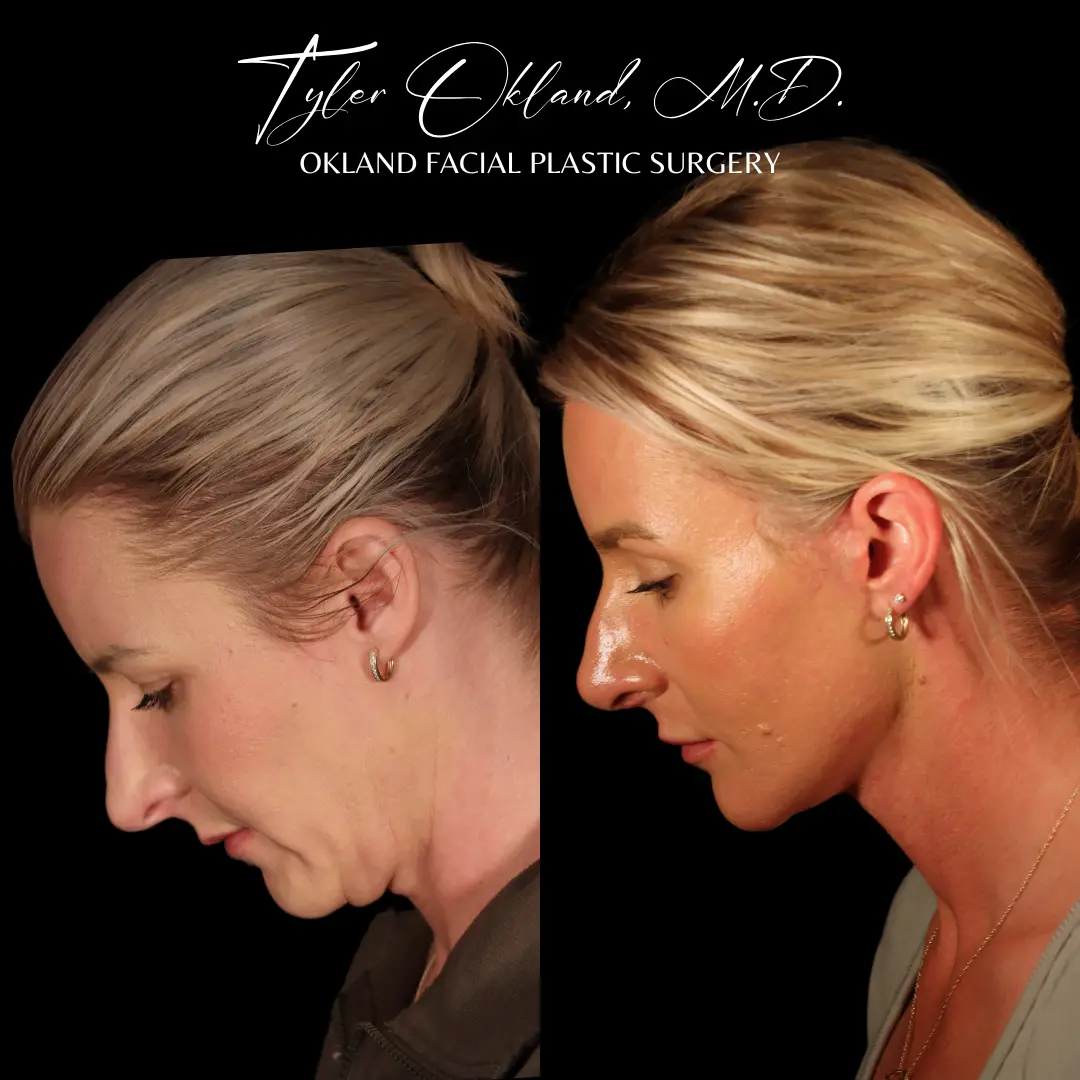 Comprehensive facial rejuvenation before and after result by Dr. Tyler Okland