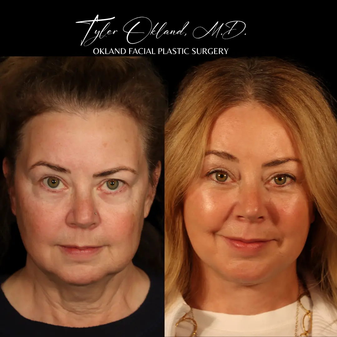 Face and neck lift before and after result by Dr. Tyler Okland