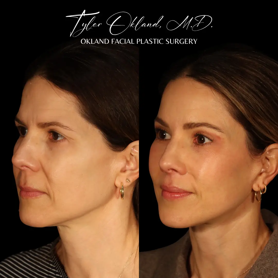 Facial rejuvenation before and after result by Dr. Tyler Okland