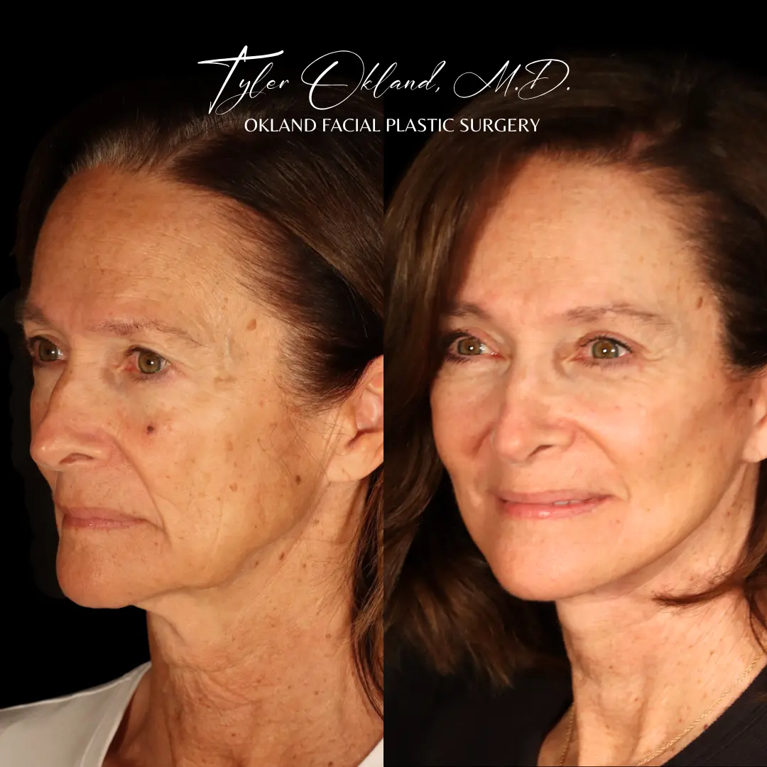 Deep plane facelift before and after result by Dr. Tyler Okland