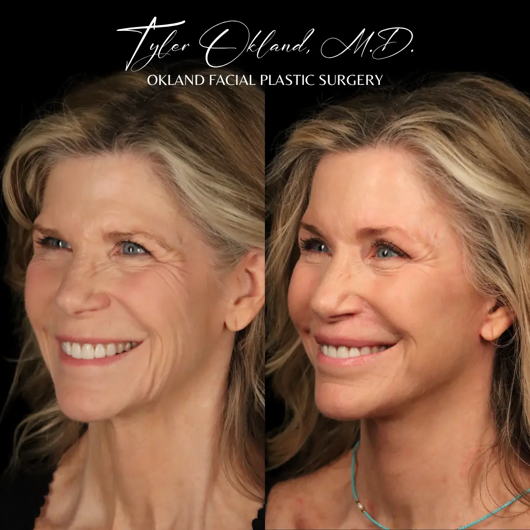 Comprehensive facial rejuvenation before and after result by Dr. Tyler Okland