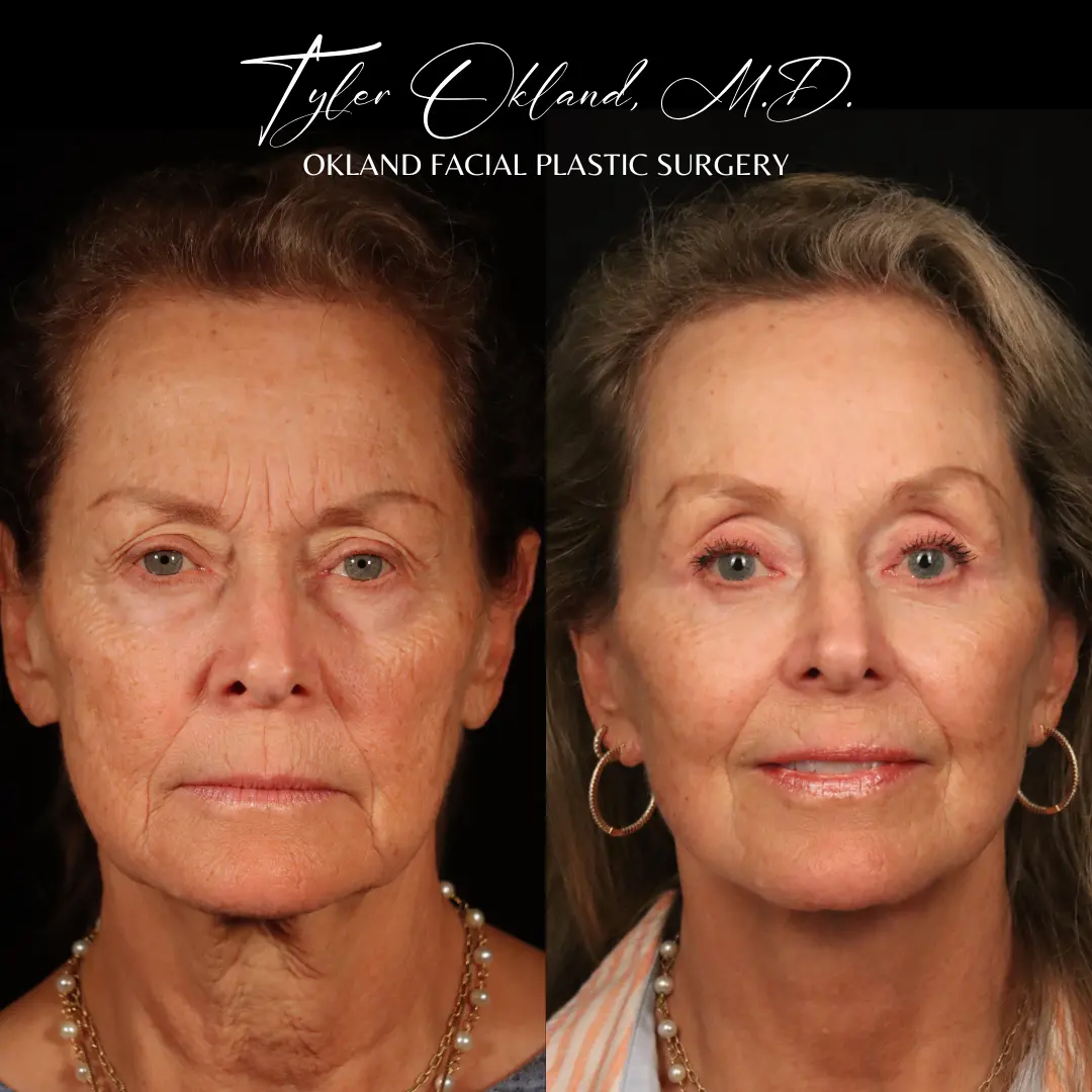 Before and after deep plane facelift and facial rejuvenation by Dr. Tyler Okland in Denver, case 04