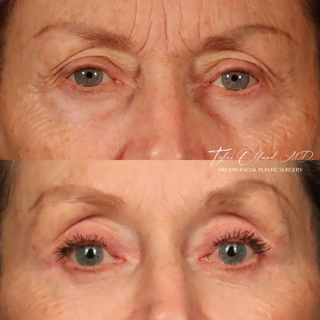 Eye-area before and after facial rejuvenation by Dr. Tyler Okland