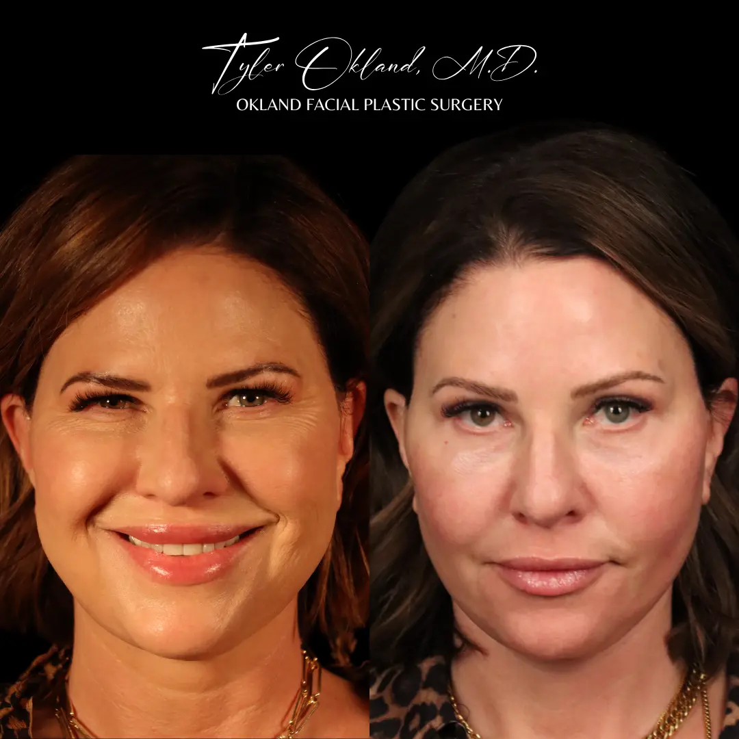 Before and after deep plane facelift and facial rejuvenation by Dr. Tyler Okland in Denver, case 06