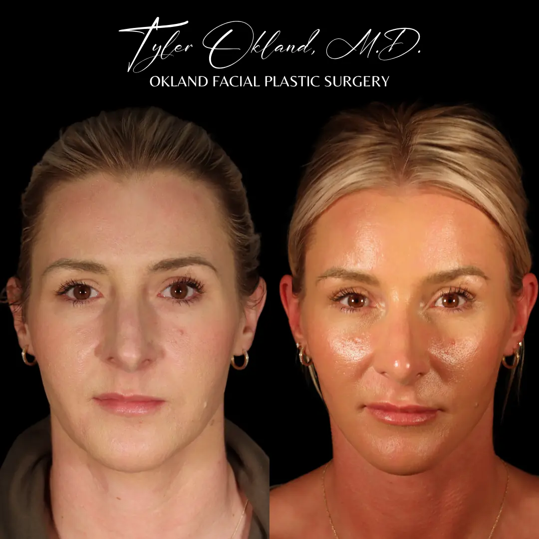 Before and after deep plane facelift and facial rejuvenation by Dr. Tyler Okland in Denver, case 05