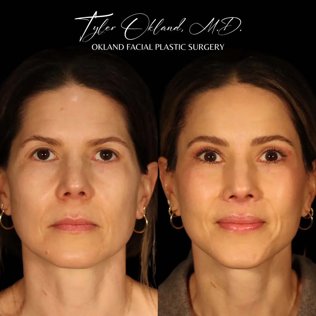 Before and after deep plane facelift and facial rejuvenation by Dr. Tyler Okland in Denver, case 02