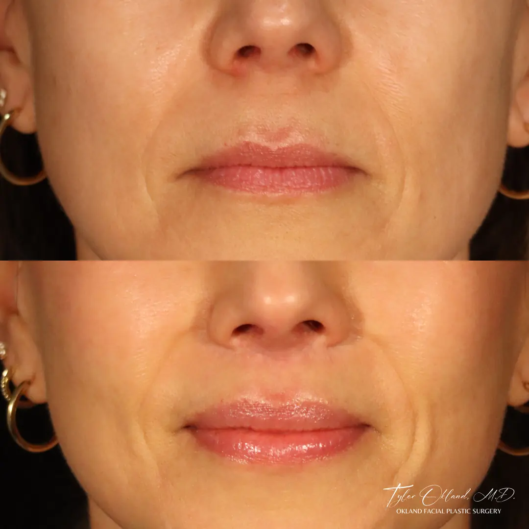 46 yo female 1.5 years out from deep plane facelift, deep necklift, endoscopic browlift, lip lift, upper blepharoplasty, custom fat transfer.