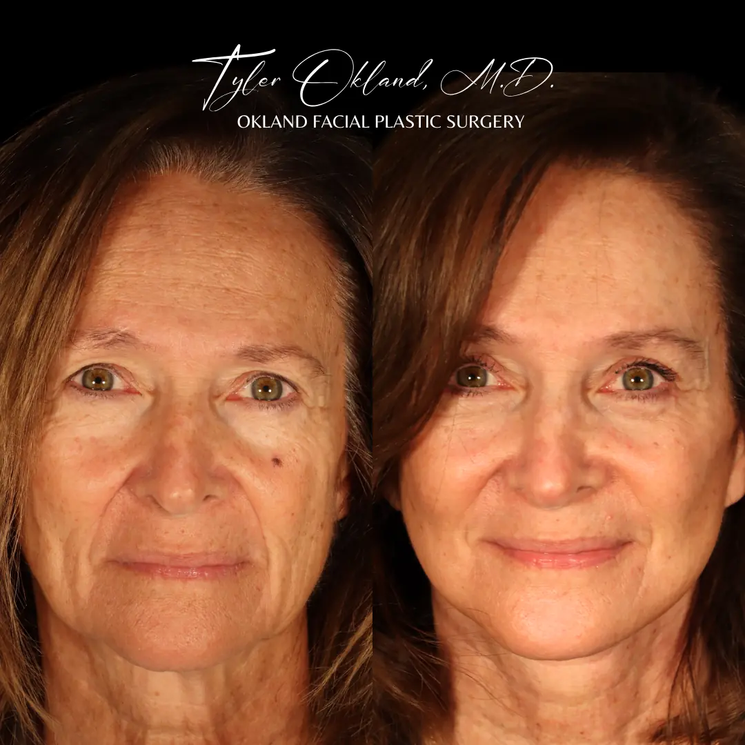 Before and after deep plane facelift and facial rejuvenation by Dr. Tyler Okland in Denver, case 08