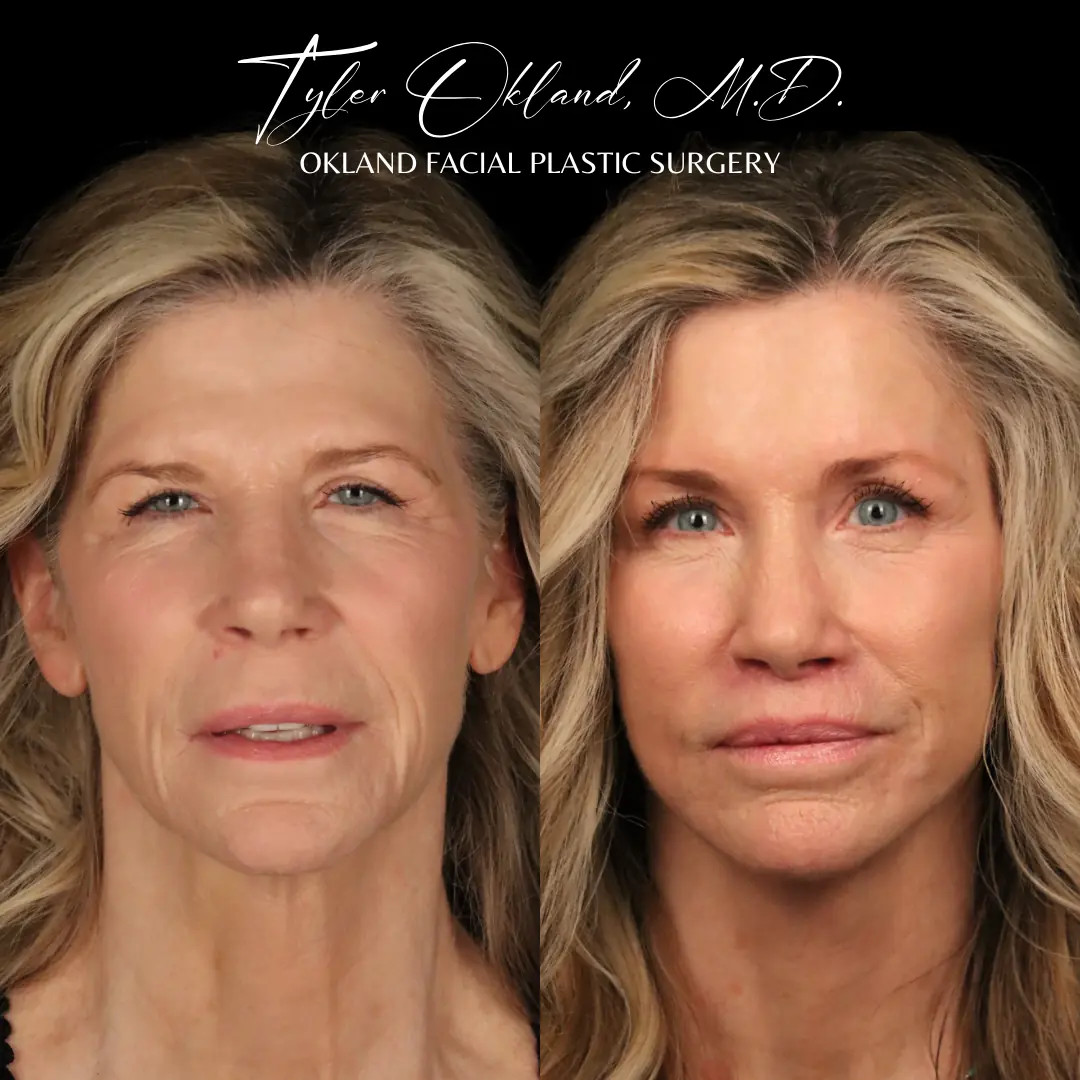Before and after deep plane facelift and facial rejuvenation by Dr. Tyler Okland in Denver, case 03