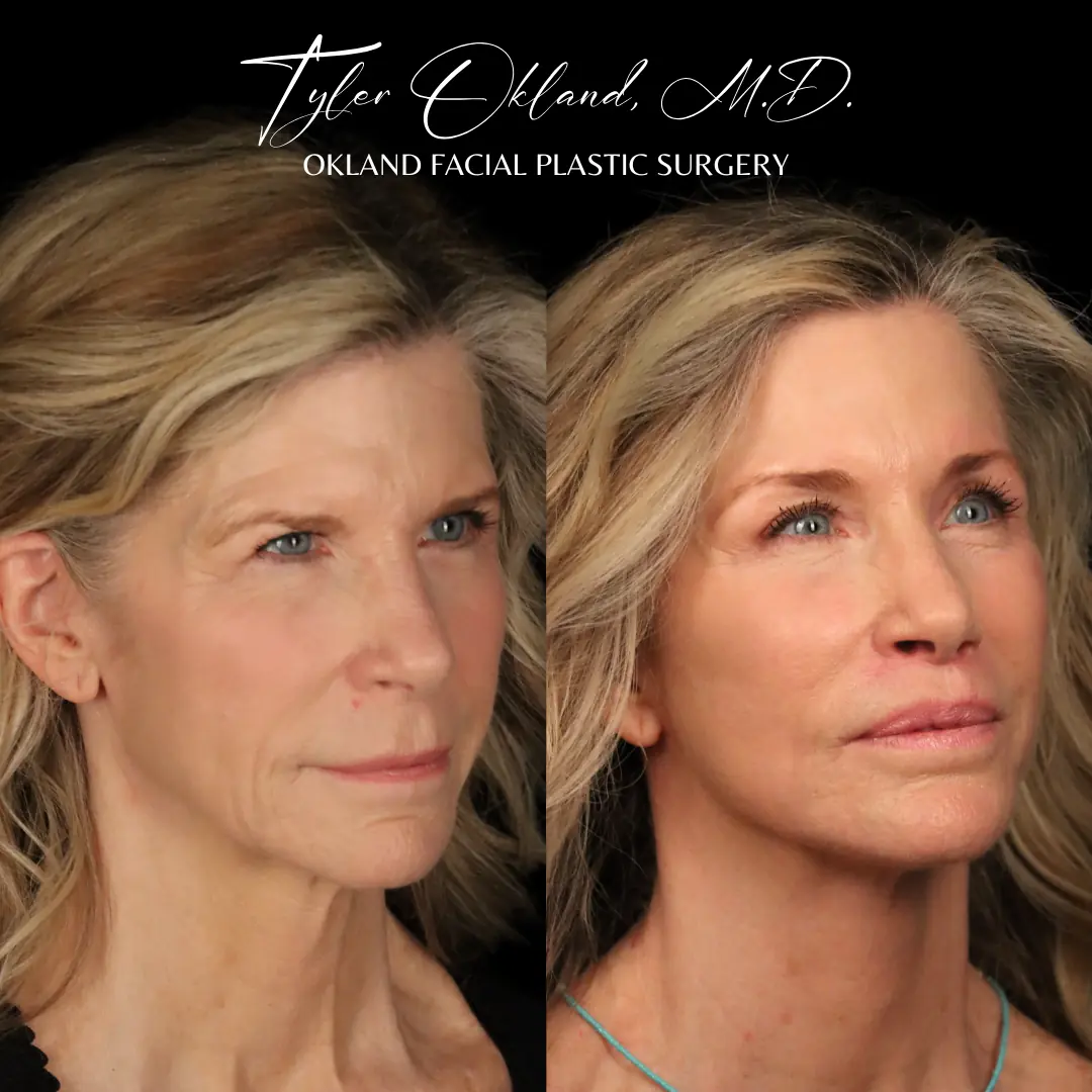 63 year old female 4 months following endoscopic browlift, extended deep plane facelift, lip lift, full face fat transfer.