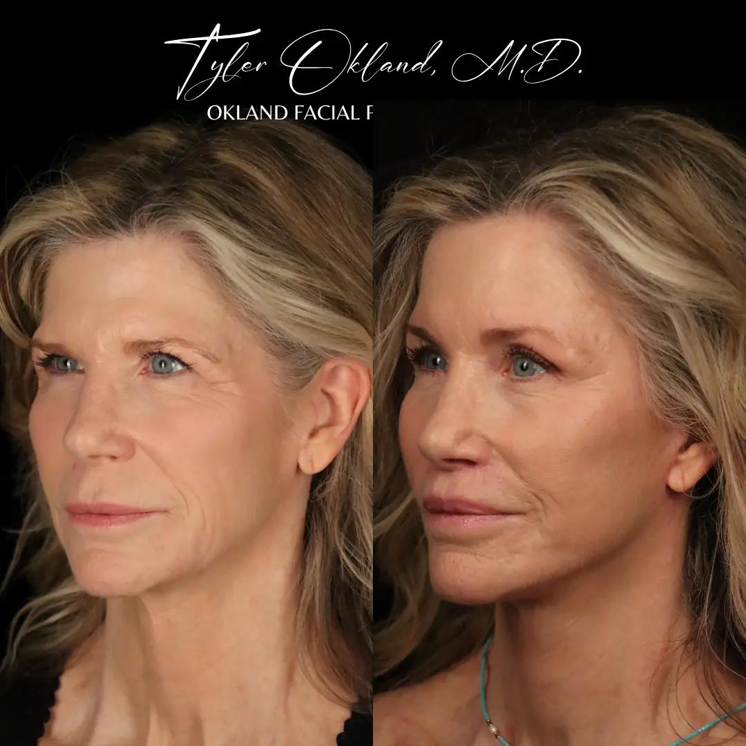 63 year old female 4 months following endoscopic browlift, extended deep plane facelift, lip lift, full face fat transfer.
