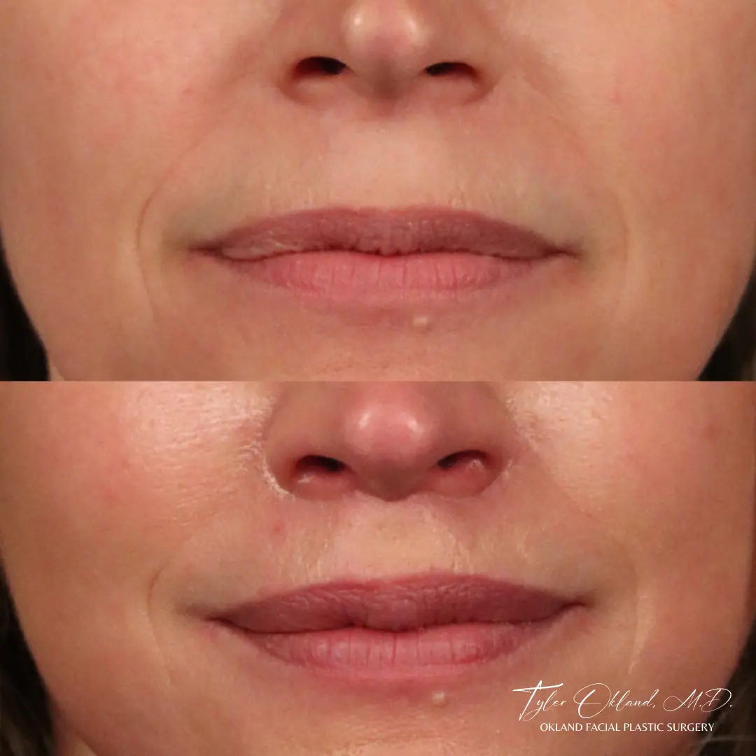 56 year old female 2 months out from lip lift.