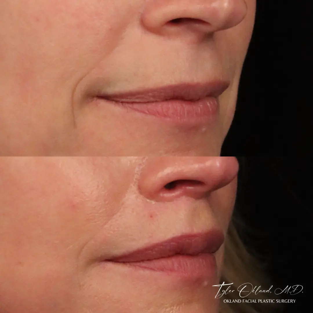56 year old female 2 months out from lip lift.