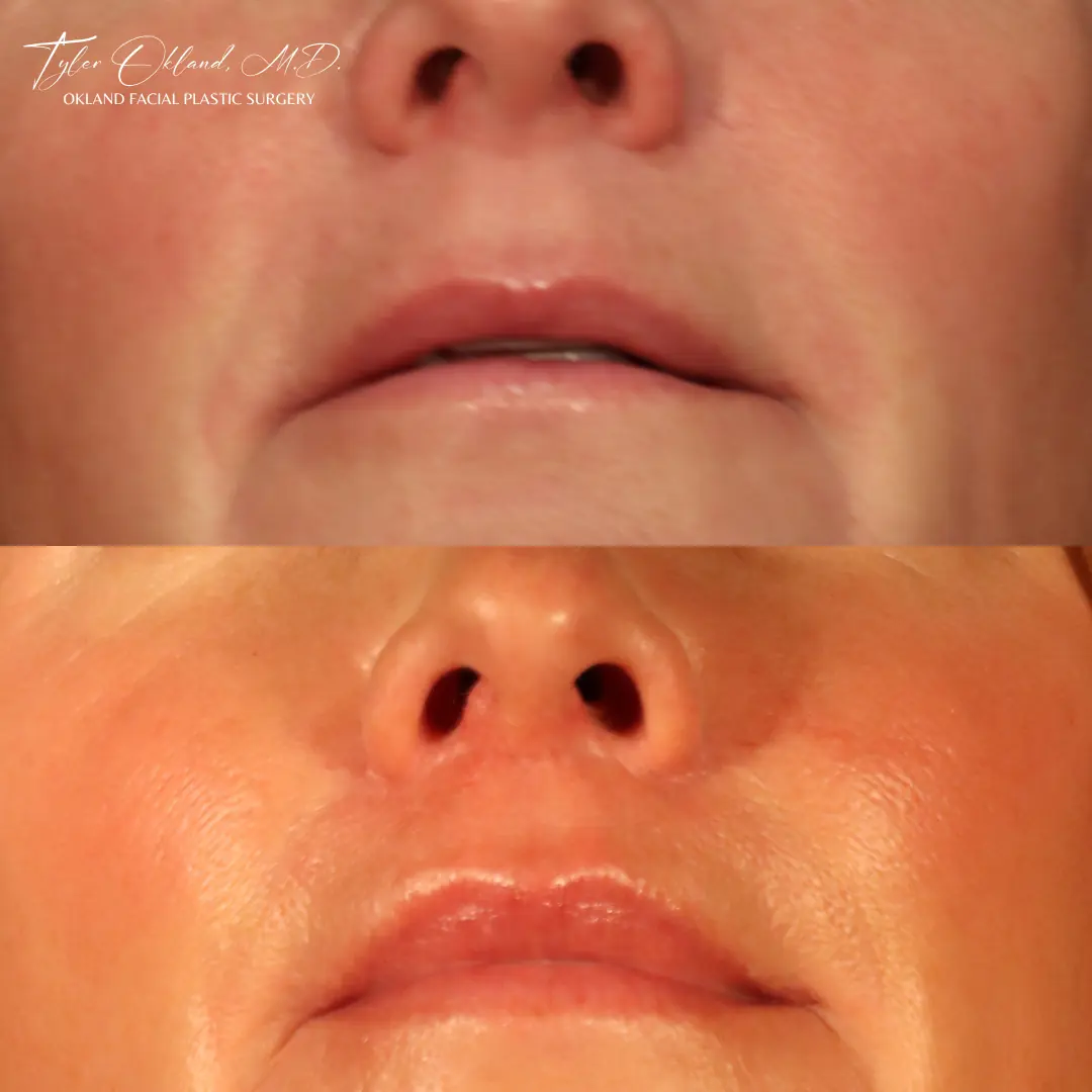 60-year-old female 6 months following lip lift with fat transfer to the lips