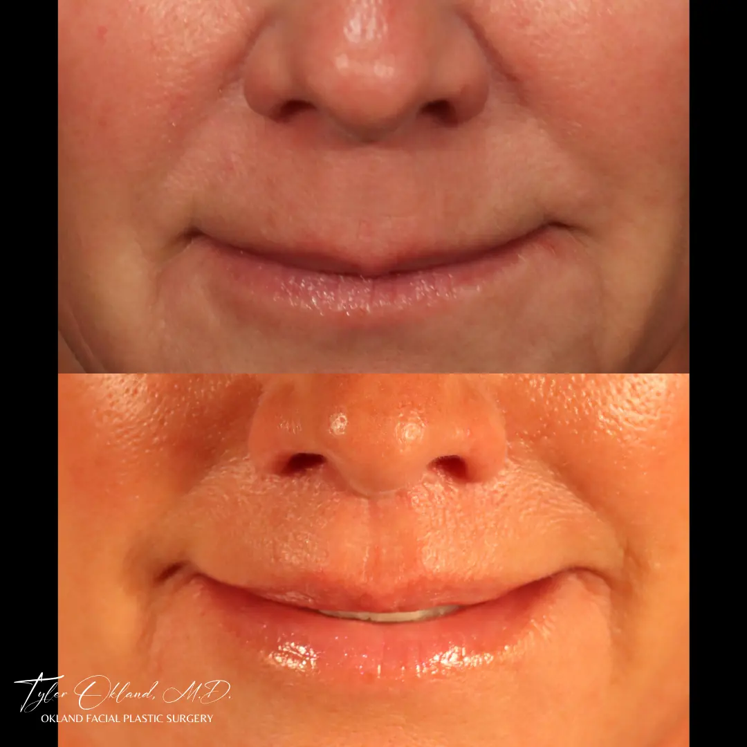 60-year-old female 6 months following lip lift with fat transfer to the lips