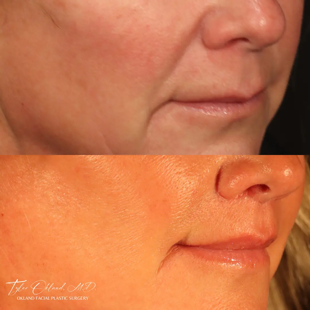 60-year-old female 6 months following lip lift with fat transfer to the lips