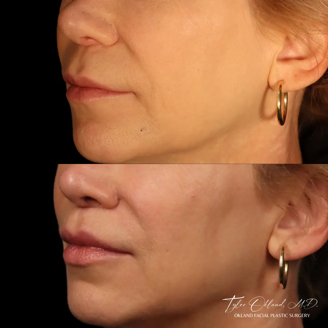 63 year old female 2.5 years after lip lift