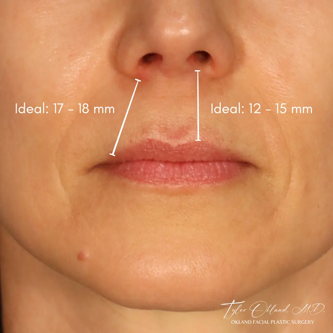 Upper lip and philtrum measurements used in Dr. Okland’s lip lift planning.