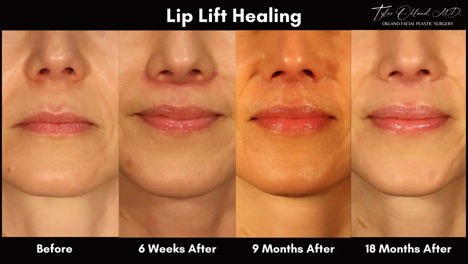Scar healing at the nasal base after subnasal lip lift.