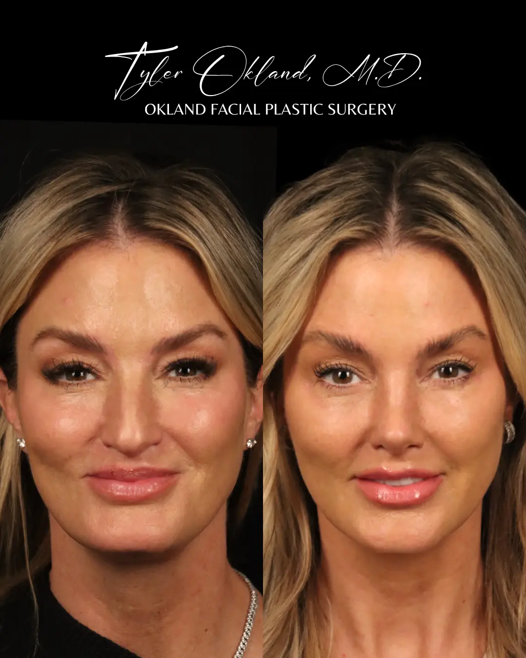 Frontal before and after primary rhinoplasty result for a 47-year-old female treated by Dr. Tyler Okland in Denver